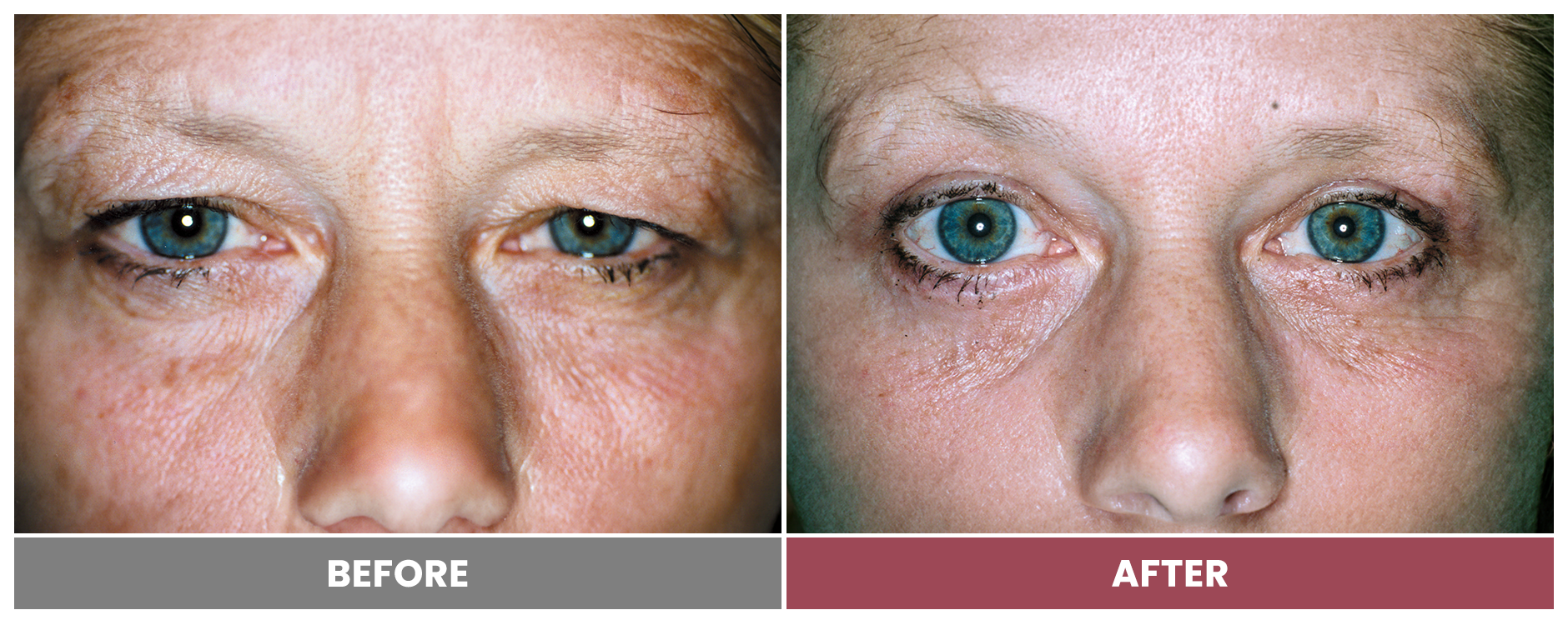 Upper Blepharoplasty - Case 37